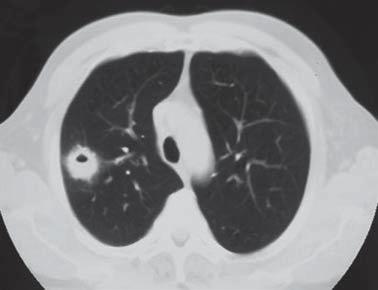 SOLITARY PULMONARY NODULE should, in any case, be the first step in the management of an SPN.