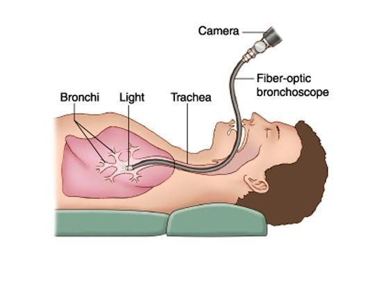 Continued Improvements Shigedo Ikeda developed the fiberoptic bronchscopy in 1964 Potentially it allowed access to modules in all areas of the lung.
