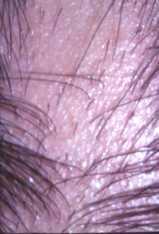 Distribution of hair loss Localized Diffuse Pattern Hair