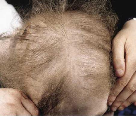 Loss of anagen hairs Usually broken off > shed Cause Radiation
