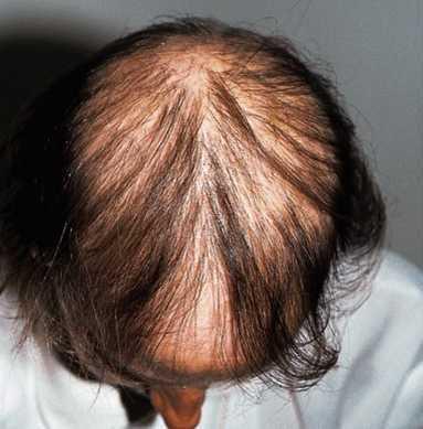 Regrowth rapidly after stop chemotherapy