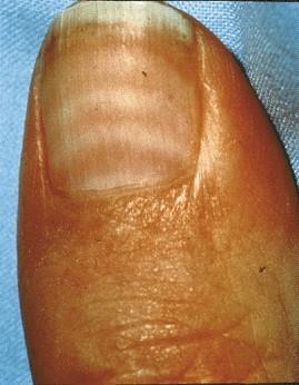 Paired, narrow white bands parallel the lunula in the nail