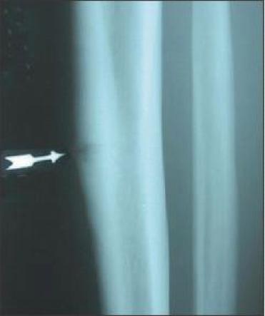 BONE SCAN A longitudinal uptake pattern along the distal one third of the tibia Treatment Rest, Ice Nonsteroidal anti