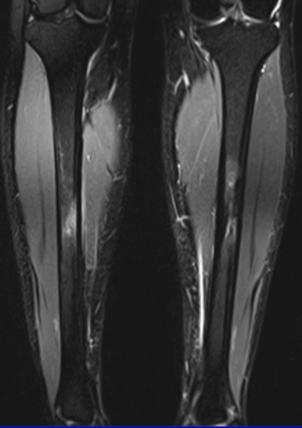 Stress fracture Repetitive loading Tibial Stress fractures account for 50% of all stress fractures Most : Proximal