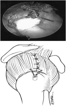 Preparation Portal Position Bursectomyvisualization Tear Patterncrescent,
