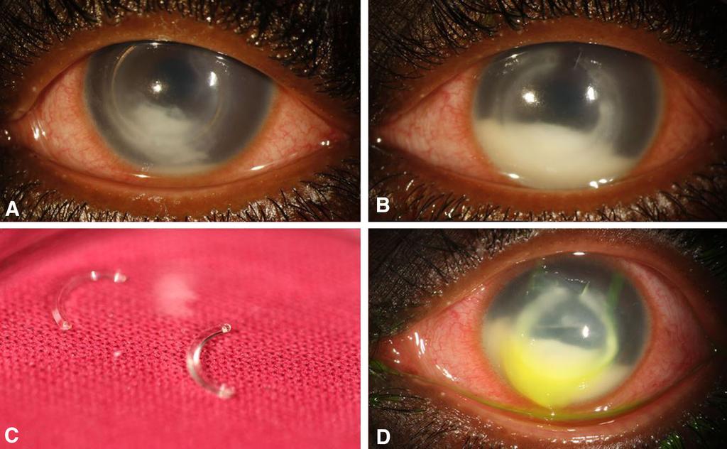 Ophthalmol Ther (2017) 6:367 371 369 Fig. 2 Evolution of the case. a Day 3 after ICSR implantation. A whitish corneal infiltrate appeared in the inferior union of both rings.