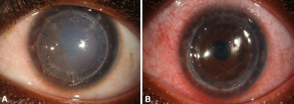 3 a Four months after therapeutic penetrating keratoplasty. Corneal edema and loose stitches. b Second penetrating keratoplasty manual technique.