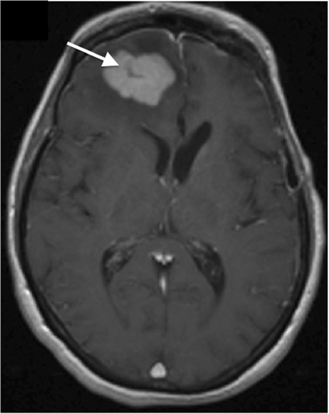 Mansour et al. Cancer Imaging 2014, 14:22 Page 5 of 9 Figure 3 Axial pre-contrast T1WI shows a hyperintense mass in the right temporal lobe.