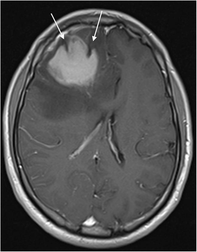 Mansour et al. Cancer Imaging 2014, 14:22 Page 7 of 9 with leptomeningeal spread in two-thirds and with parenchymal disease in only one-third of cases [4].