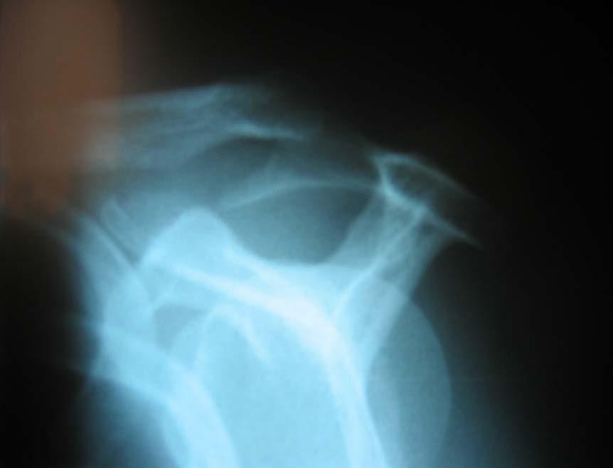 Impingement Syndrome Primary Rotator Cuff