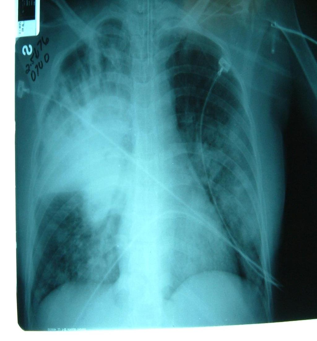 Case of Severe CAP 30 y/o female presents to ER at 0400 with acute fever, cough, dyspnea;