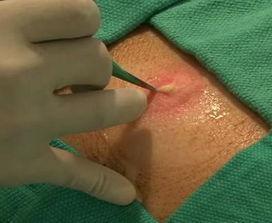 Management of MRSA Infections Hospitalize those suspected of having serious infections and, following cultures, initiate empiric therapy For skin/soft tissue infections (SSTI) incision and drainage