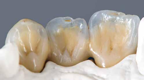 Thanks to their great colour stability, the Vintage PRO porcelains allow me to quickly and reliably create aesthetic restorations