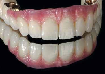 GUM COLORS Free and individualised gingiva reproduction CERAMAGE UP GUM COLORS The new gingiva-coloured Ceramage UP Gum materials can be applied directly from the dispenser to add gingival areas to