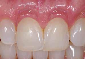 Clinical case, before and after restoration with BEAUTIFIL II Gingiva Light Pink The five Beautifil II Gingiva shades, which can be blended with each other, allow users to reproduce true-to-nature