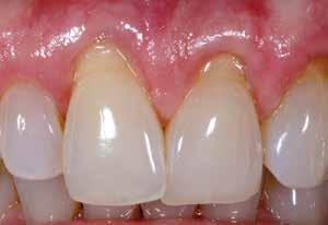 They are indicated primarily in cases of gingival recession, exposed abutments and crown margins, root erosion and missing papillae, and perfectly suited for Class V and other restorations.