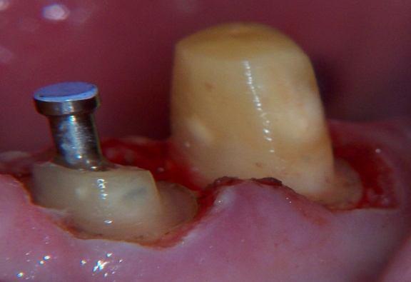 The cast gold post and core was cemented in initially (using RelyX automix, 3M, ESPE) Figure 6, and an impression taken thereafter for the fabrication of the definitive crowns.