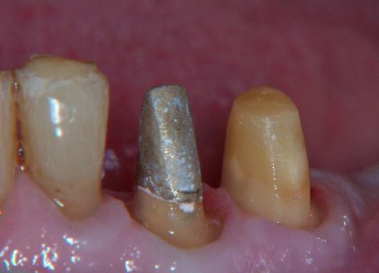 Figure 6. Cast post and core in situ; 6 weeks post-gingivectomy. The LR3 has been prepared with adequate ferrule.