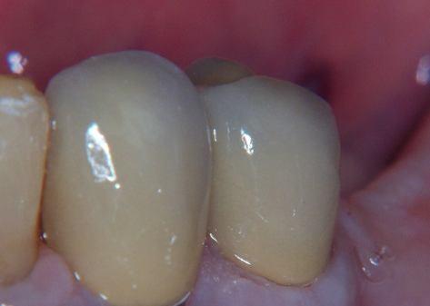 It has been estimated that approximately 40% of coronal tooth structure may be compromised when preparing a tooth to receive an onlay restoration; whilst this statistic appears rather gloomy, it