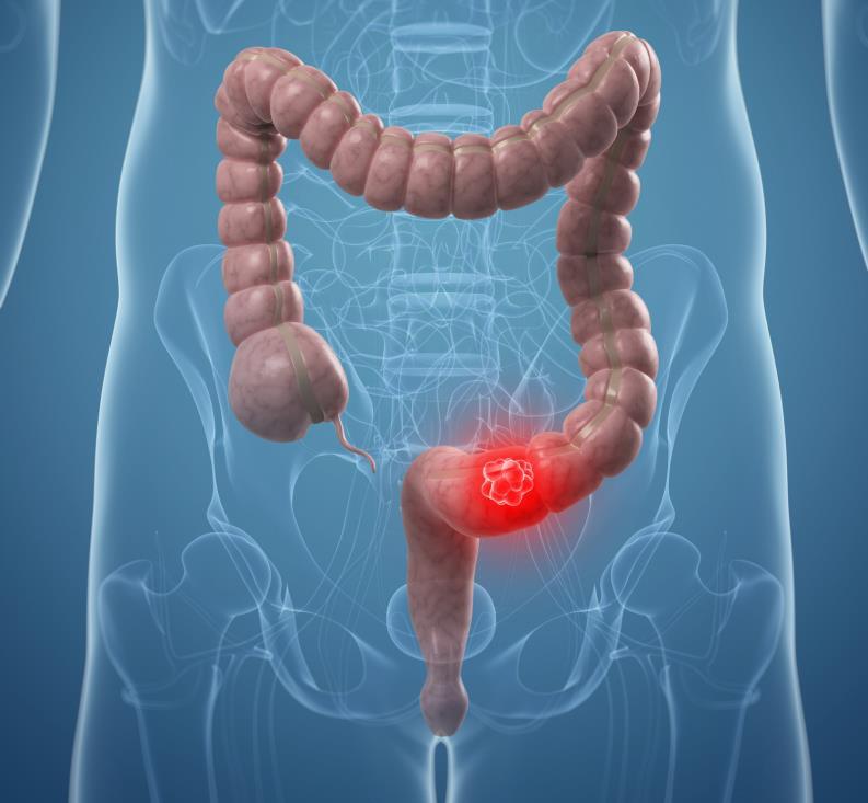 Colorectal Cancer In the U.S.