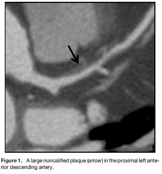 Net Reclassification based upon CCTA in Asymptomatic Individuals 7,590 individuals without known CAD or chest pain syndrome (61% male; 58+12 years) undergoing both CACS and CCTA, followed for 24
