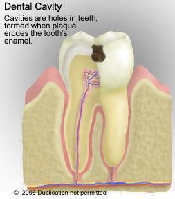 Teeth - Cavities Result from a gradual demineralization of enamel and underlying dentin by bacteria Dental plaque (film