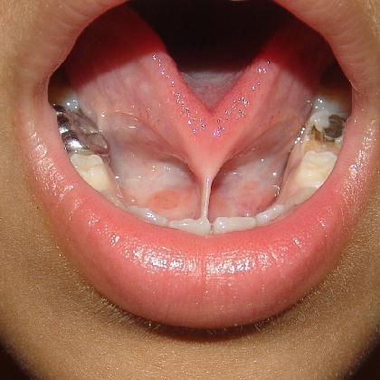 Lingual frenulum secures tongue to floor of mouth, limits posterior movements Ankyloglossia ( fused tongue