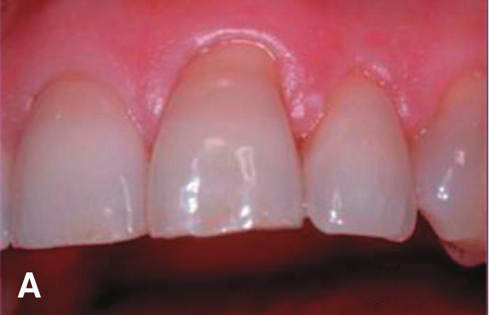 Gingival Recessions Treated With Envelope Technique Volume 75 Number 10 improvement in terms of root coverage. Two grafted teeth had partial loss of grafted tissue in the first week.