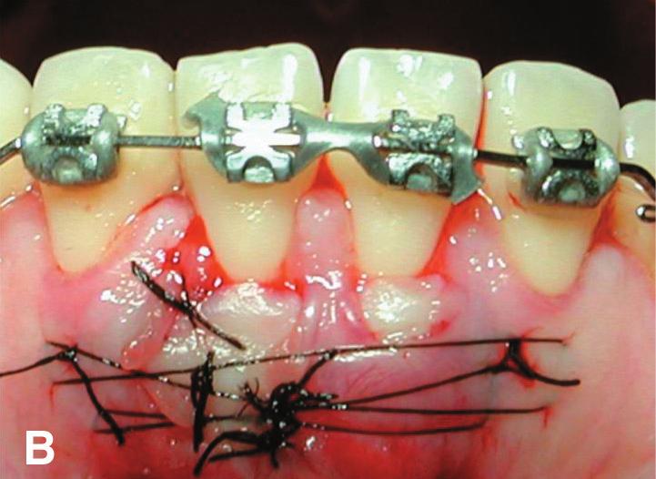 The recession on tooth #9 was classified as Class I and was treated with a connective tissue graft using a conventional envelope technique.