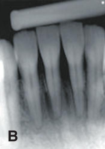 The diagnosis included a Class II localized recession and a mucogingival problem in the area. An envelope technique was performed.