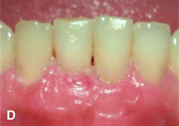 3) A 42-year-old female patient consulted because of progressive gingival recession and presence of sensitivity to cold in the area of tooth #7.