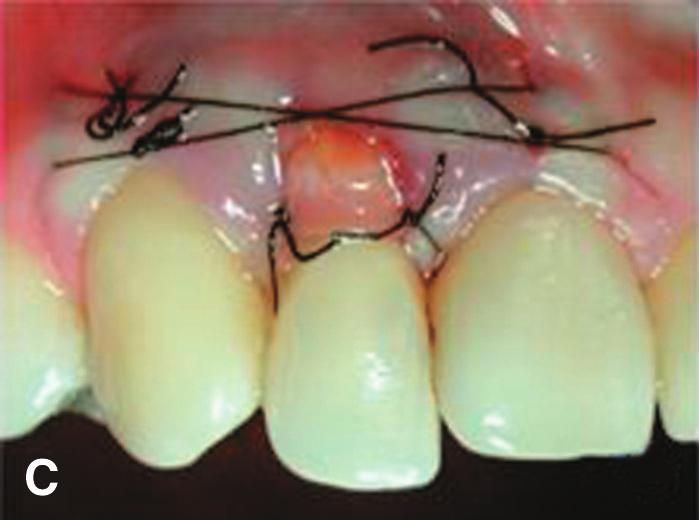 Probing depths ranged from 2 to 3 mm in the area and the tooth had Class II mobility.