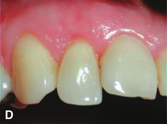 Both interdental papillae had receded and the recession was classified as Class III according to Miller.
