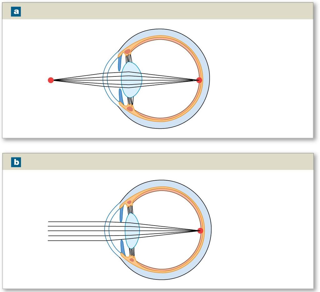 Figure 17-11 Accommodation For Close Vision: Ciliary Muscle Contracted, Lens Rounded Lens rounded Focal point on fovea