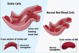 Sickle cell disease (SCD) is a genetic disease of the red blood cell characterized by vaso-occlusion and hemolysis.