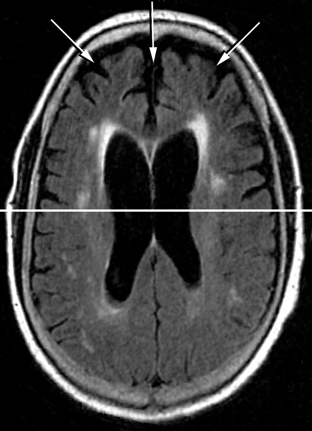 MRI Scan in a Patient with FTD Anterior