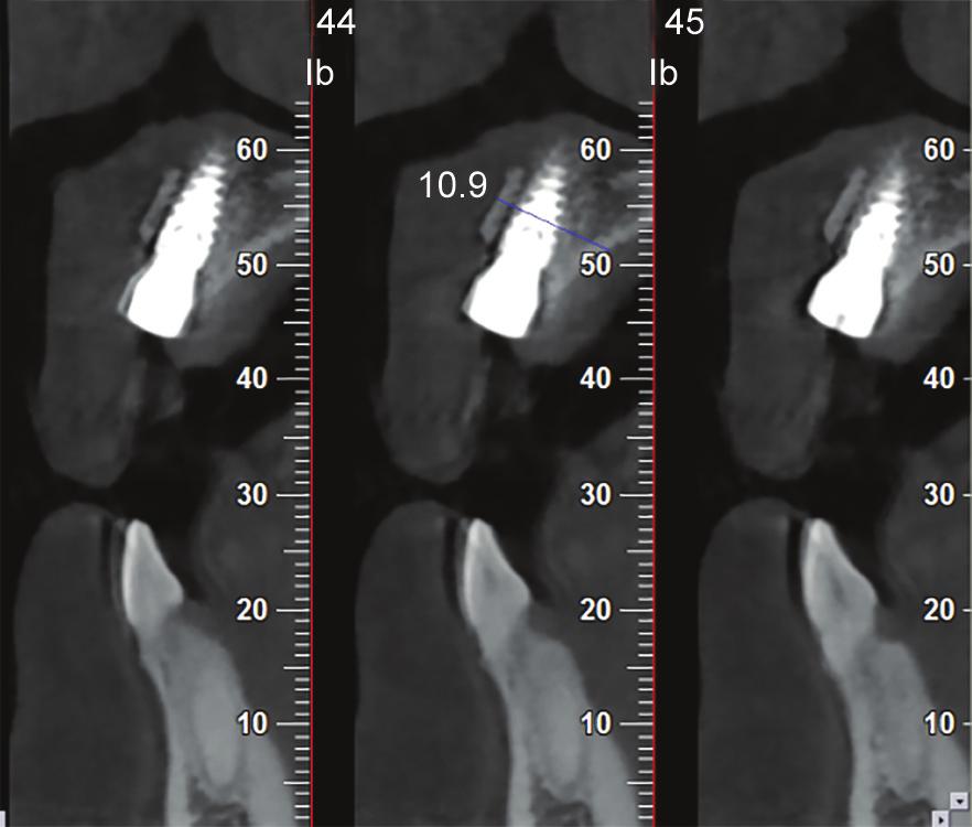 Mogammad Thabit Peck Fig. 10: Sagittal CBCT at the time of implant exposure reconstruct lost alveolar bone for the purposes of placing dental implants.