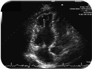 Transthoracic ECHO McConnell s Sign Indicative of RV strain Regional wall motion abnormalities that spare the RV apex Suggestive of acute PE Patient 4 Thrombus was extracted from the main and branch