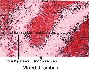 (3) mixed thrombus Constitution: fibrin with meshed red blood cells between platelet layers