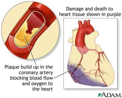 Infarction Definition: An infarct is an area of ischemic necrosis within a tissue or an