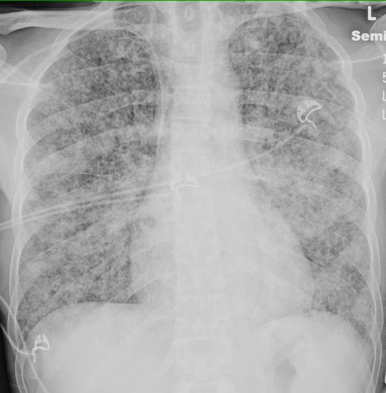 Hospitalized 2 weeks later QuantiFERON negative Lung bx shows granulomas, AFB