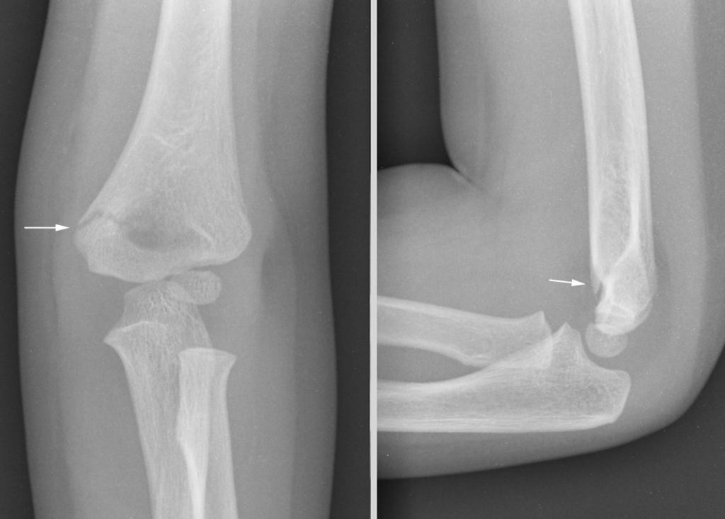 Fig.: Fig.7AP and lateral elbow views in a 3 year old child. The supracondylar fracture line is seen on both views (arrows).