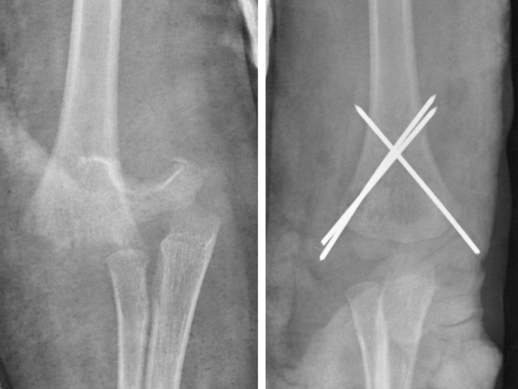 Fig.: Fig.8Pre- and post-operative AP views of a transphyseal fracture in a 4 year old child. There is separation of the entire distal humeral epiphysis on the preoperative image (left).
