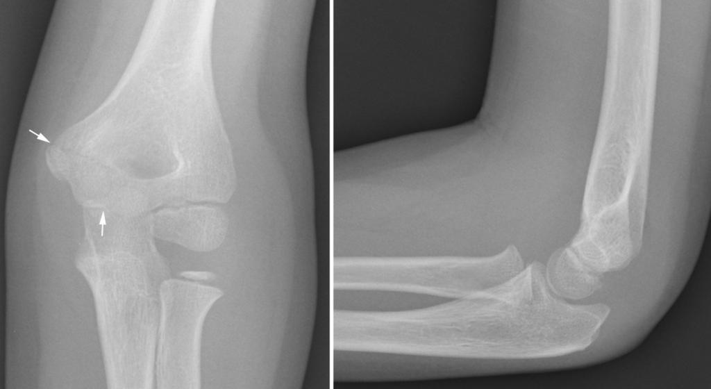 Fig.: Fig.11AP and lateral elbow views in an 8 year old child.
