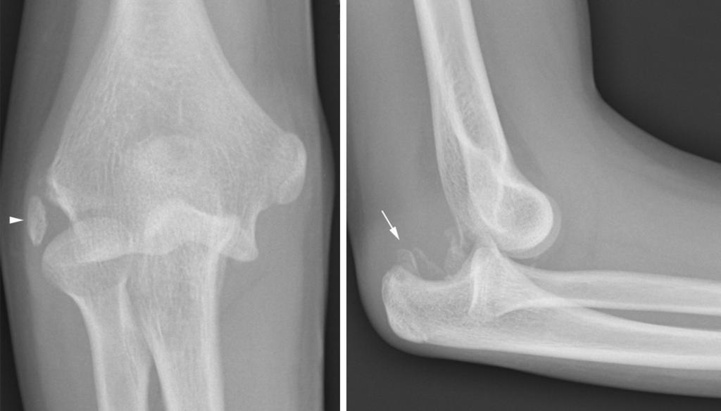 Fig.: Fig.14Anterior dislocation of the elbow in a 13 year old child. On the lateral view, multiple fracture fragments are seen within the joint space (arrow).