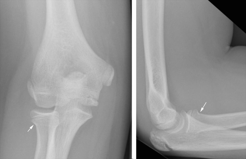 Proximal radial fractures: most commonly 6-13 years mechanism of injury: valgus force on extended elbow shearing force associated injuries: proximal ulna and medial epicondyle fractures