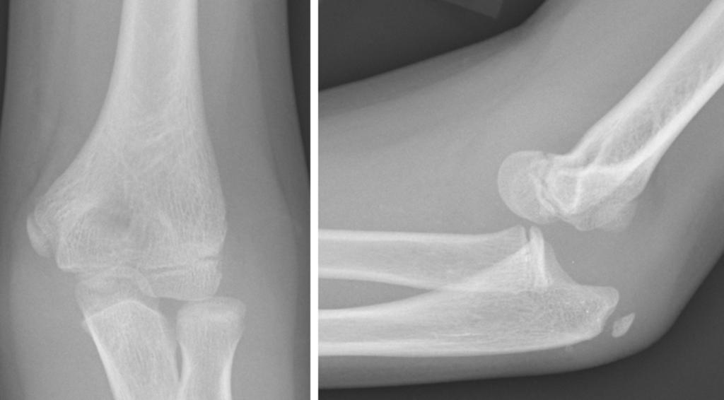 Fig.: Fig.23AP and lateral views in an 11 year old child demonstrating anterior dislocation of the elbow. Fig.: Fig.24AP and lateral elbow views in an 11 year old child.