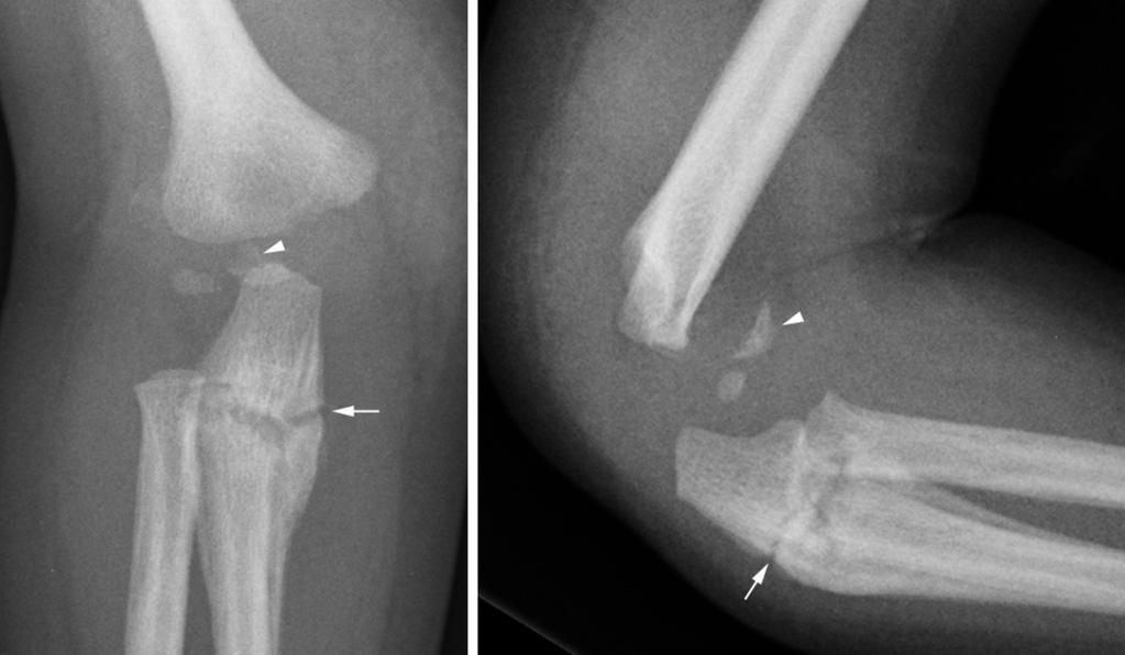 Non-accidental injury (NAI): most frequently in under 2 year old child often no history of injury or inadequate history to explain the injury multiple fractures in different stages of healing with