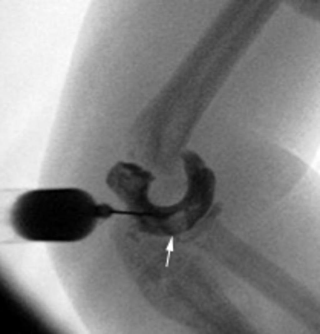 Fig.: Fig.25bArthrogram confirming that the fracture fragment (arrowhead, Fig.25a) is within the elbow joint capsule (arrow).