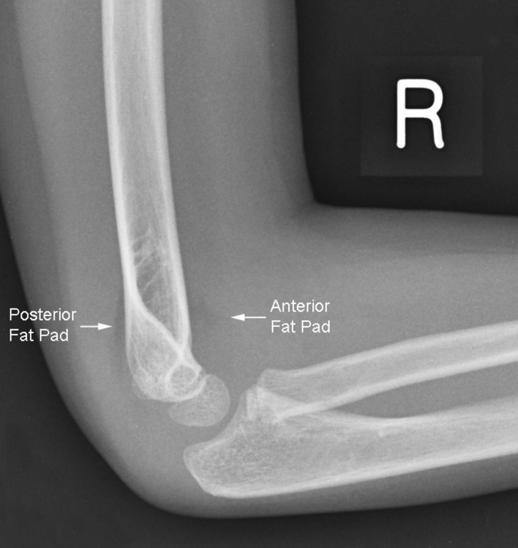 Fig.: Fig.3Lateral view of the elbow demonstrating a joint effusion. Both anterior and posterior fat pads are raised (arrows).